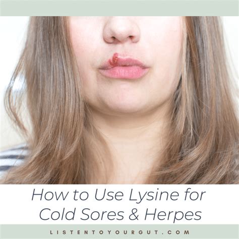 How To Use Lysine For Cold Sores And Herpes Listen To Your Gut