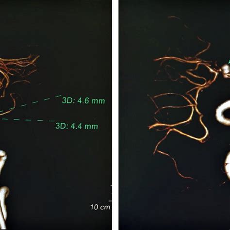 The Three Dimensional 3d Reconstruction With Ct Angiography Showed