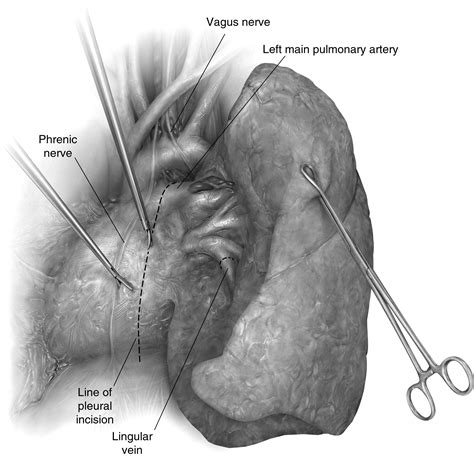 Video Assisted Thoracic Surgery Lobectomy Operative Techniques In