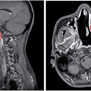 Left: mass on posterolateral sphenoid sinus which infiltrate left and ...