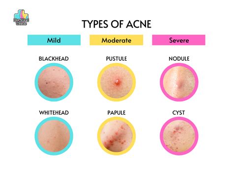 The 6 Types of Acne: How to Tell If Your Acne Is Mild, Moderate, or Severe – HowMedWorks