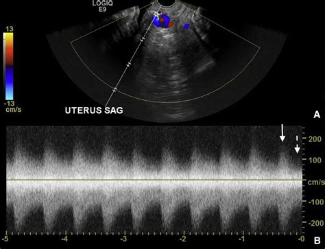 Diagnosis Of Acquired Uterine Arteriovenous Malformation By Doppler Ultrasound Journal Of