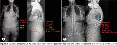 Figure 1 From The Effect Of Distal Fusion Level On Functional And