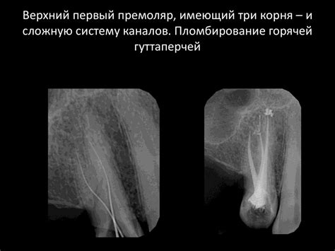 Пломбирование корневых каналов зуба - презентация онлайн