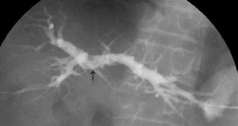 Percutaneous Transhepatic Cholangiography Showing Complete Biliary