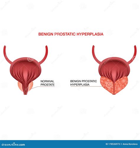 Benign Prostatic Hyperplasia Editable Vector Illustration In Realistic