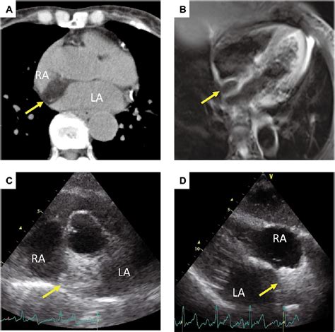 Figure From Intracardiac Echocardiography Guided Biopsy Of A