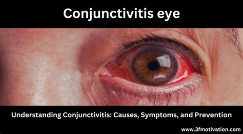 Understanding Conjunctivitis: Causes, Symptoms, And Prevention