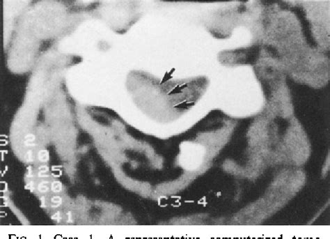 Figure 1 From Spontaneous Cervical Epidural Hematoma Semantic Scholar