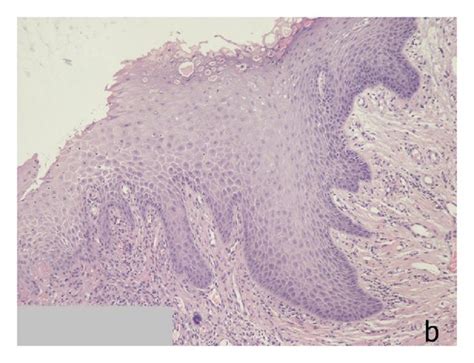 A Cytology Squamous Cells Thinprep Pap Stain ×400 B