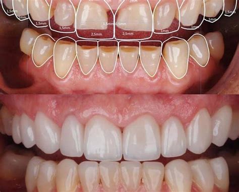 Gülüş Tasarımı DentBolu Ağız ve Diş Sağlığı Polikliniği