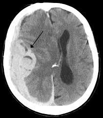 Brain Shift and Herniation – Scottish Acquired Brain Injury Network