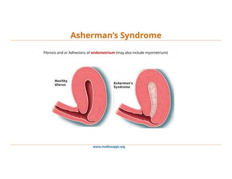 Ashermans Syndrome