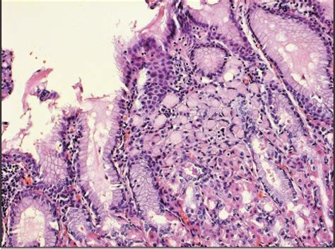 Figure 2 From HEREDITARY DIFFUSE GASTRIC CANCER GENETIC ASPECTS AND