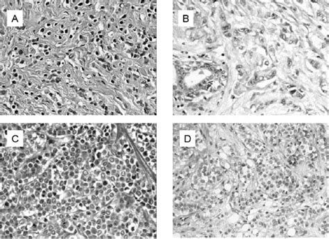 Special Types Of Invasive Lobular Breast Cancer A Classical Type