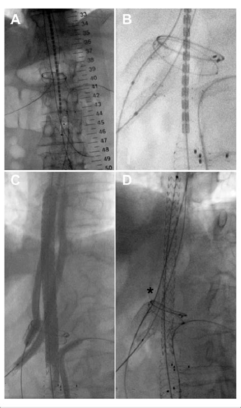 A The Nellix Stent Is Deployed From The First Available Normal Tissue