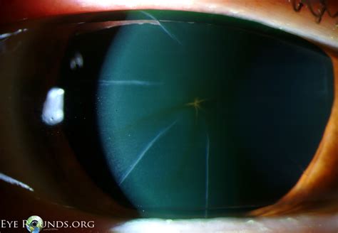 Atlas Entry Stellate Corneal Epithelial Iron Line After Radial