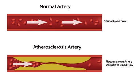 Effect Of High Lipid Levels On Blood Flow Download Scientific Diagram