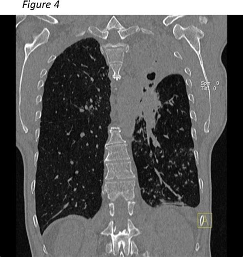 Figure 3 From Unexpectedly Long Progression Free Time In A Patient With