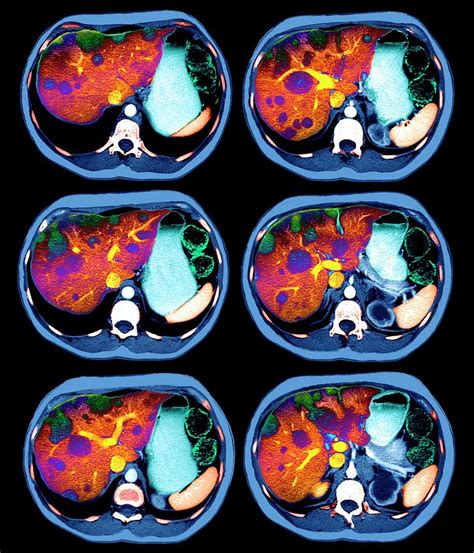 Liver Cancer By Zephyr Science Photo Library