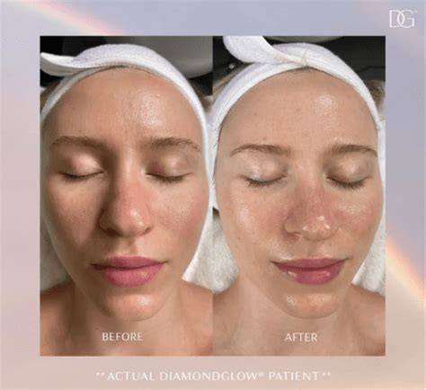 Diamond Glow Skin Rejuvenation Arria MedSpa NJ