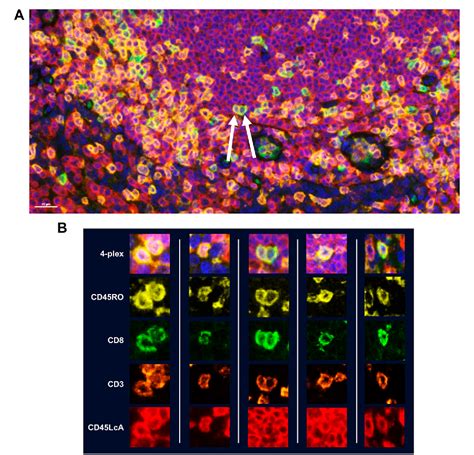 Figure 2 From Multiplex Immunofluorescence And Multispectral Imaging