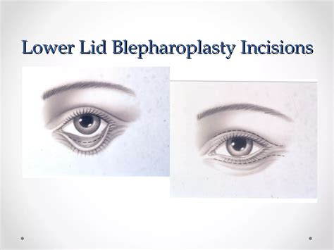 Blepharoplasty techniques | PPT
