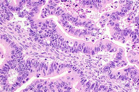 Mucinous carcinoma (ovary) - MyPathologyReport.ca