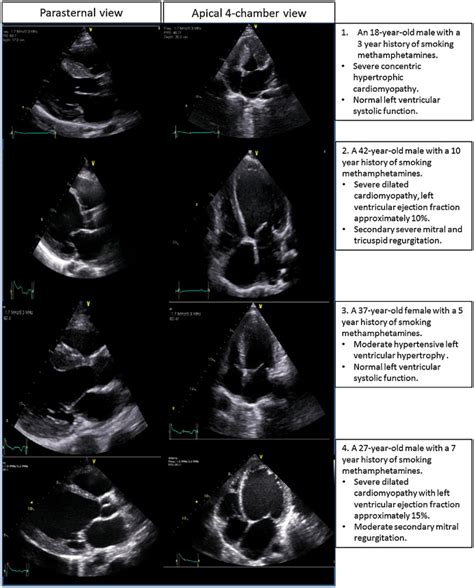 The Cardiac Complications Of Methamphetamines Heart Lung And Circulation