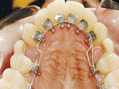 Clinical-Lingual-fig-2 : Scottish Dental magazine