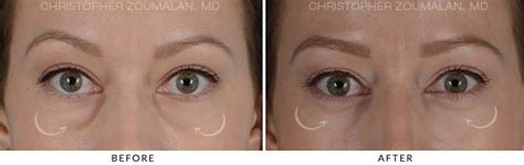 Lower Lid Blepharoplasty Before and After Photo Gallery