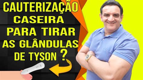 Como Remover As Gl Ndulas De Tyson Em Casa Aprenda Passo A Passo De