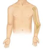 Cubitus Varus | Arlington, Dallas, Frisco & McKinney Doctor Offices