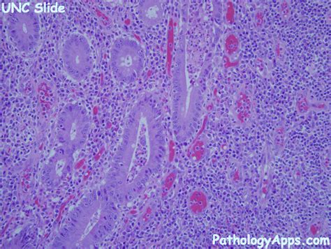 Liver Abscess Histology