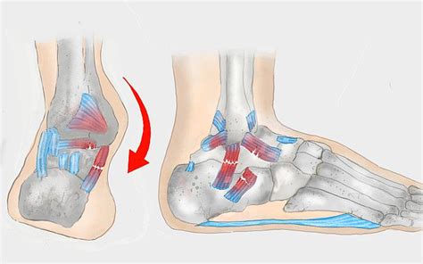 Bänderriss im Sprunggelenk Behandlung Dauer Prognose