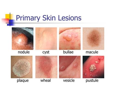 Vesicle Skin Lesion