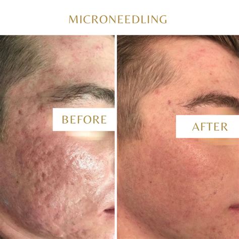 Microneedling B Sico Y Avanzado Tratamientos Con Meso Infusi N