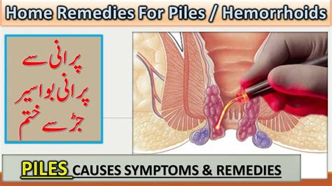 Haemorrhoids Treatment Bawaseer Ka Ilaj Piles Causes Treatment