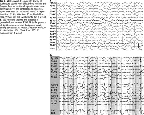 A Eeg Revealed A Moderate Slowing Of Background Activity With Diffuse