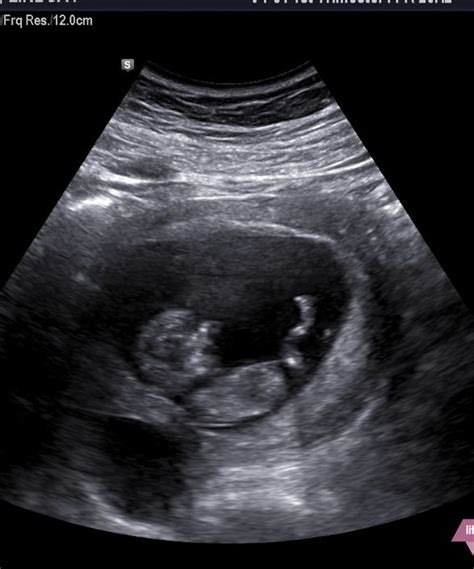 Fetal movement on ultrasound? - August 2024 Babies | Forums | What to ...