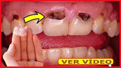 Os Dentistas NÃO Querem Que Você Saiba Esse Truque TIRA A CÁRIE em 3