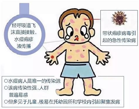 水痘的症状和治疗图片水痘图片大全小儿水痘第3页大山谷图库