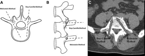 A B And C Illustration Of Entry Points Of Pedicle Screws Via