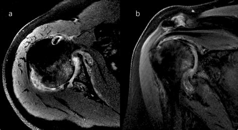 Right Shoulder Magnetic Resonance Imaging Proton Density Weighted