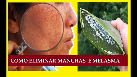 Como Tirar Melasma Manchas Na Pele E No Rosto Em Poucos Dias Youtube