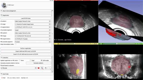 Mri Us Fusion For Prostate Hdr Brachytherapy Youtube