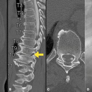 Case Demonstrating Utilization Of Navigation For Full Endoscopic Spine