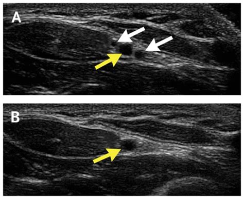 Ultrasound Guided Radial Arterial Line Placement Sifsof