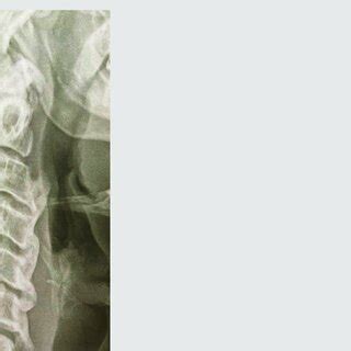 Plain X-ray of the sacroiliac joints showing signs of sacroiliitis ...