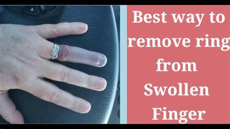 Remove Stuck Ring From Swollen Finger Easy And Effective Way Life Hack